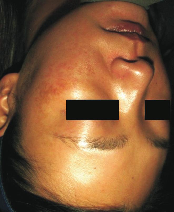 satisfaction with the appearance of their melasma lesions after seven to eight treatment sessions, regardless of whether they underwent treatment with pulsed RF alone or combination treatment (Figs.