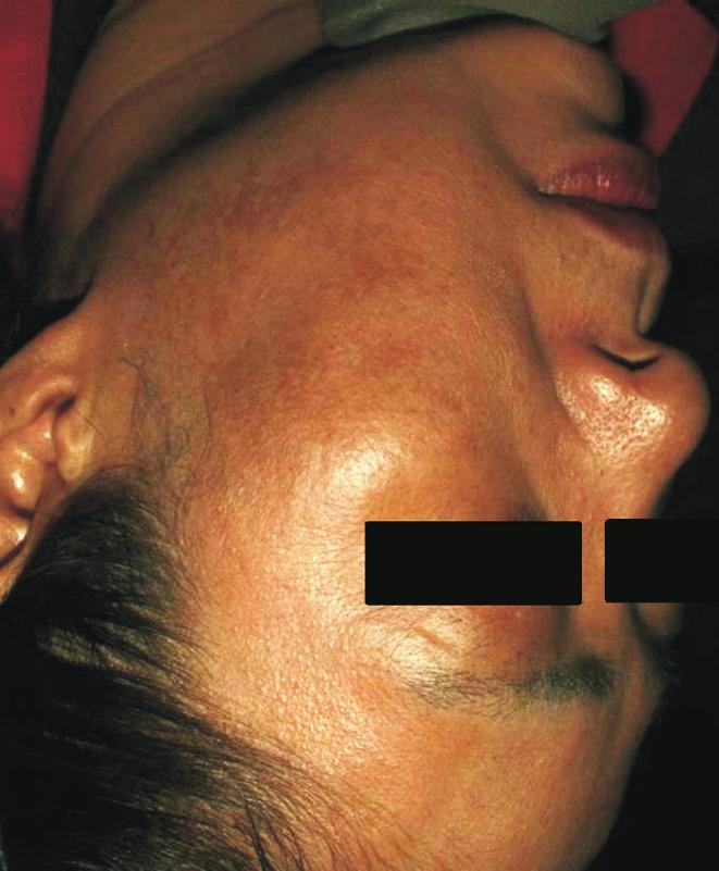 Invasive Pulsed Bipolar Radiofrequency Hyoung Moon Kim and Min Ji Lee A B Fig. 4. Representative photographs of a 56-year-old female patient with melasma and rebound hyperpigmentation.