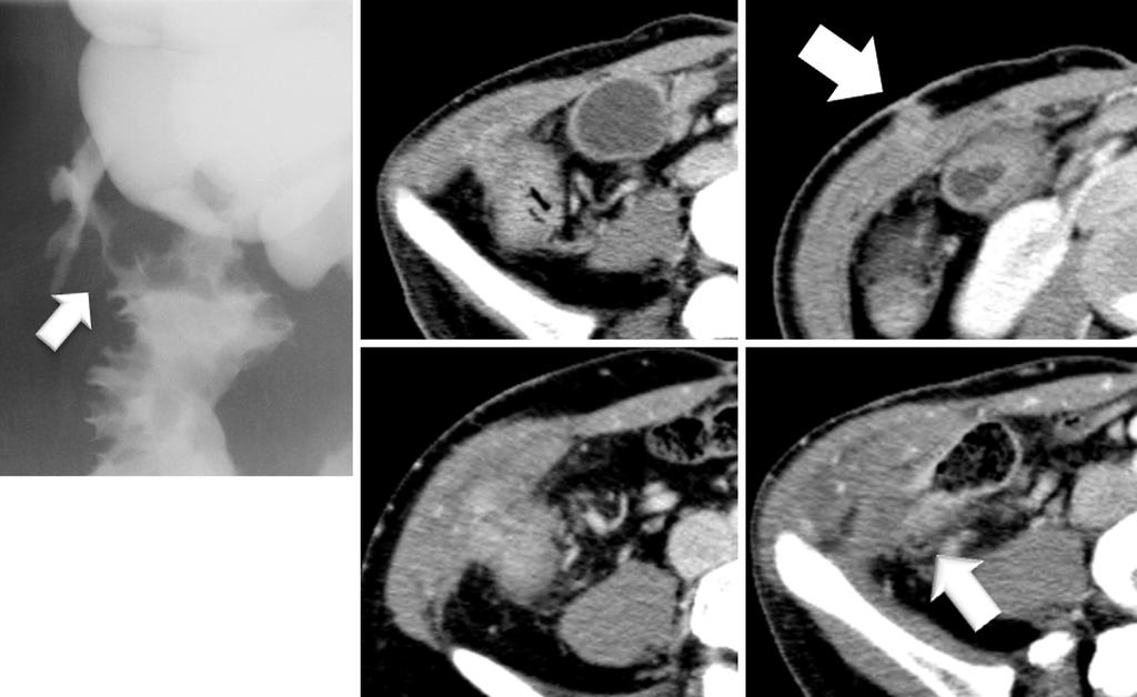 A B C D E Figure 1. An enterocutaneous fistula in a 31-year-old man (Case 1). A: A water-soluble radiocontrast enema examination revealed an enterocutaneous fistula (arrow).