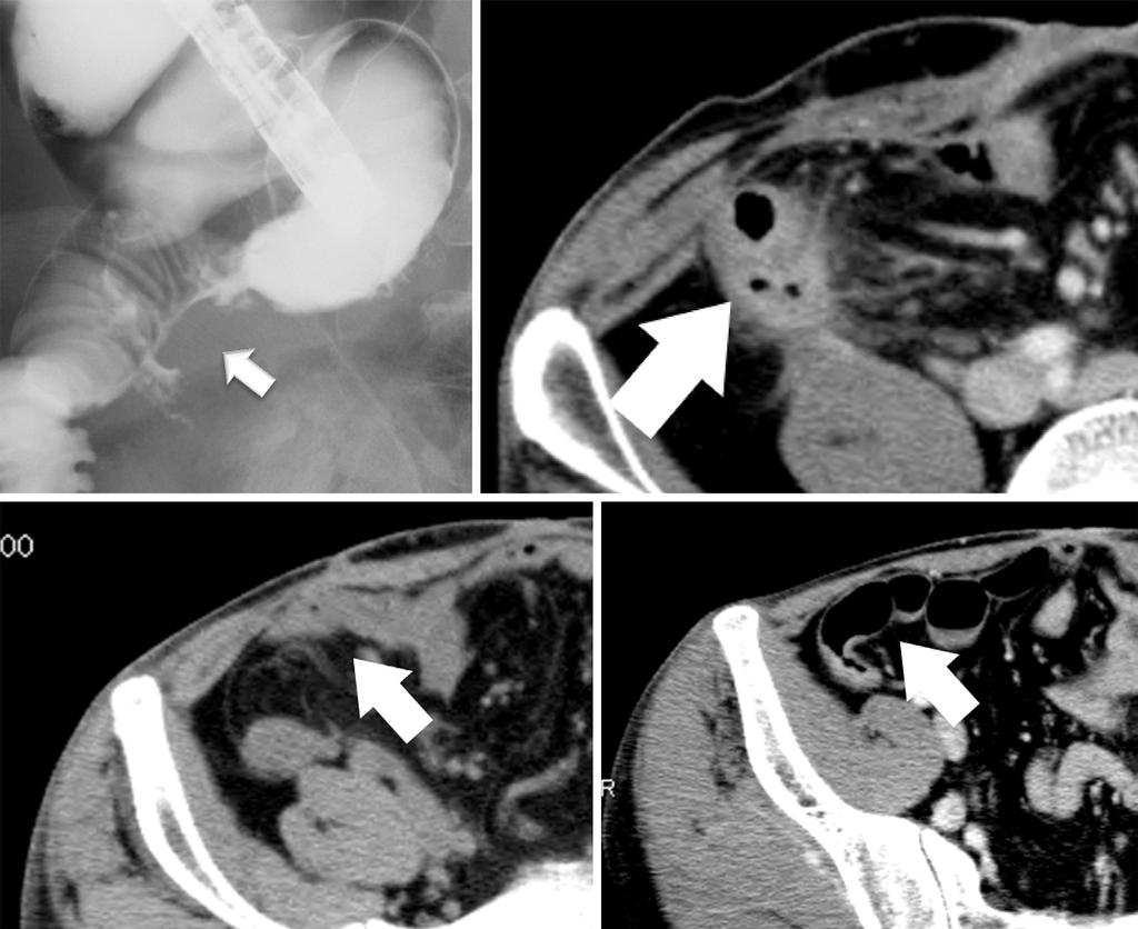 A B C D Figure 2. Closure of an enterocutaneous fistula in a 43-year-old man (Case 3). A: A water-soluble radiocontrast enema examination revealed an enterocutaneous fistula (arrow).