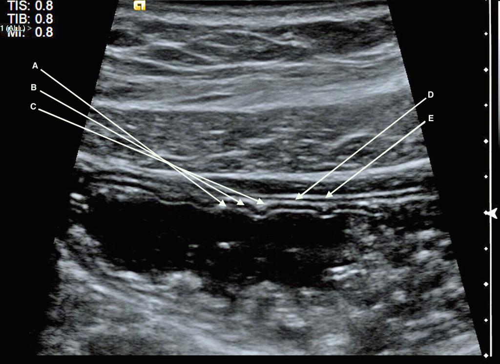FIGURE 1. Image of the normal stomach demonstrating the normal layers of bowel in general: (A) Innermost echogenic line representing the interface between bowel lumen and mucosa.