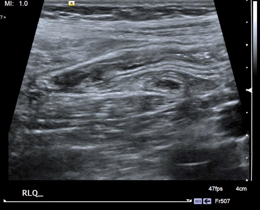 Figure 4. Week 14 after medical therapy. Note return of normal bowel wall signature and the absence of free fluid. input.
