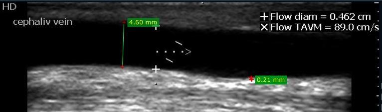 CASE OBSERVATIONS Figure 5-US grayscale image in longitudinal plane demonstrating the intima-media thickness as 0.