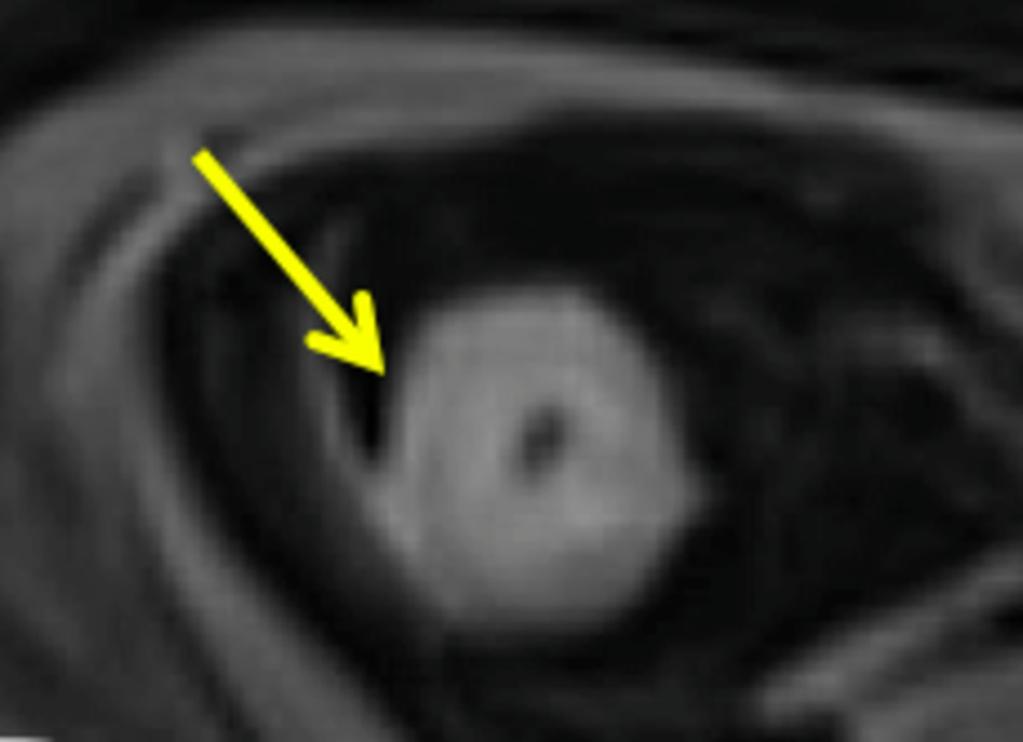 Fig. 6: A T1 post contrast image demonstrating an image of layered enhancement