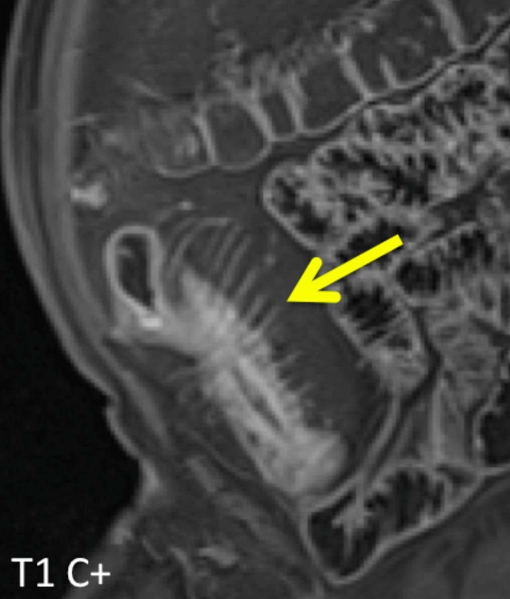 Fig. 8: "Comb sign" of the engorged vasa recta