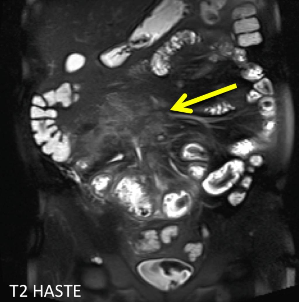 Fig. 10: A T2 fat sat image demonstrating mesenteric edema
