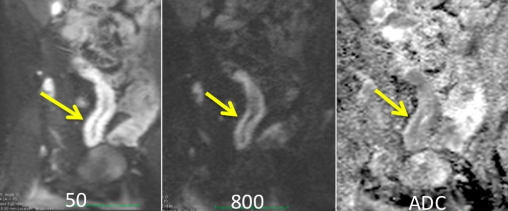 Fig. 11: Diffusion weighted imaging is a relatively new technique and merging as an important tool in the assessment of actively inflamed bowel.