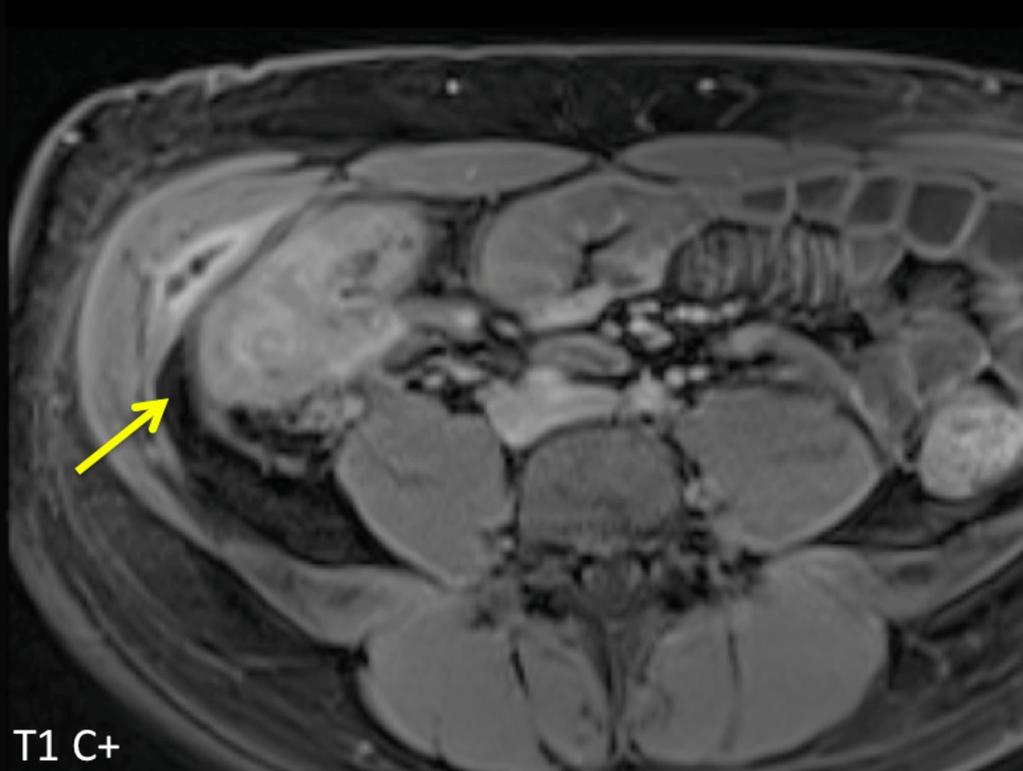 Fig. 12: A T1 post contrast image of an abscess adjacent to a loop of actively inflamed bowel