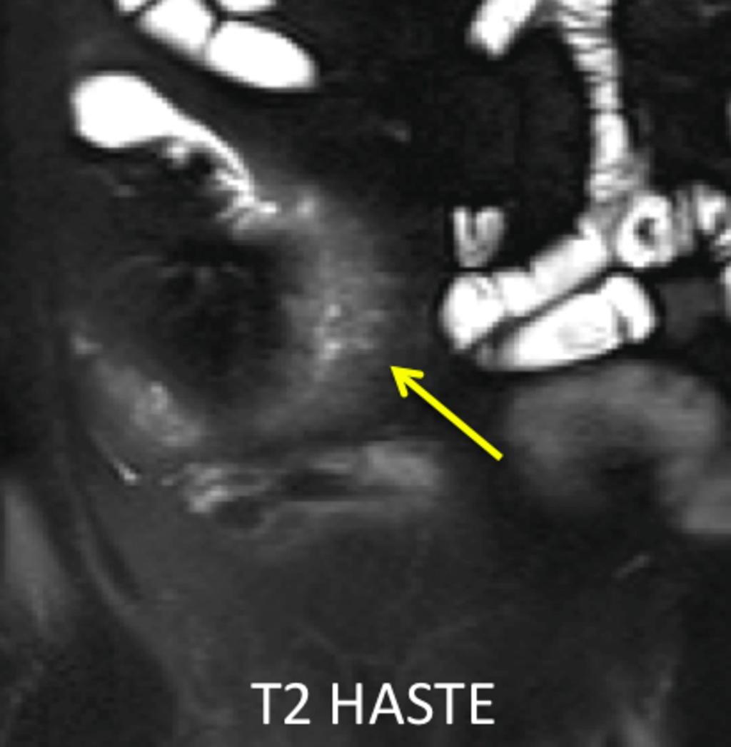 Fig. 13: Extensive deep transmural ulcers in chronic active (perforating disease) as demonstrated by T2 bright lines