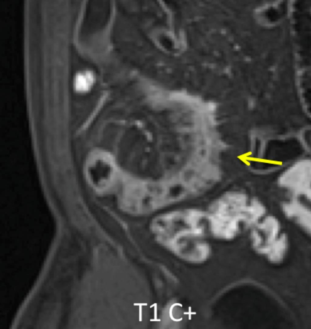 Fig. 14: The same deep transmural ulcers as in fig.