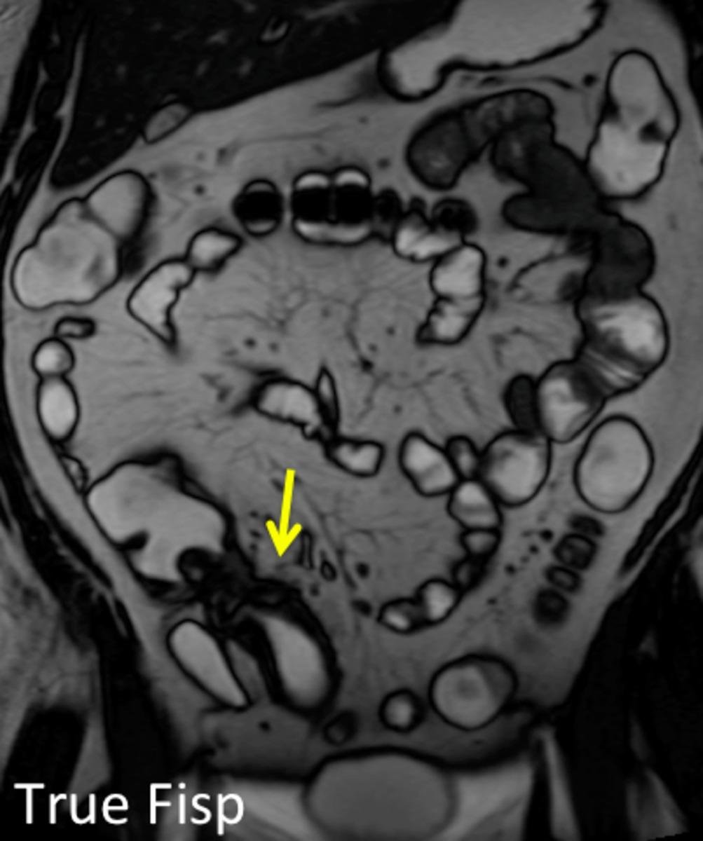 Fig. 15: Thickened terminal ileum (yellow arrow), difficult to assess the
