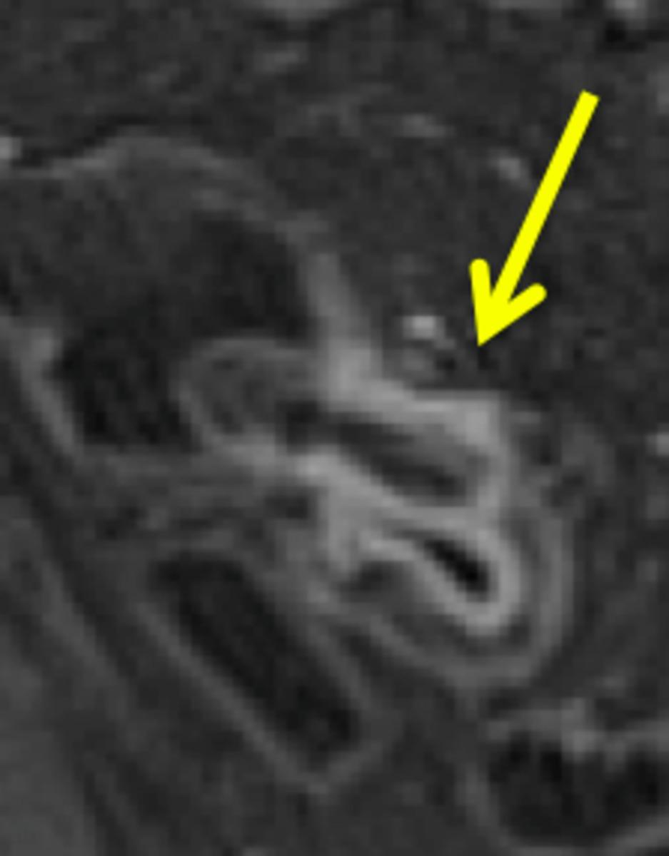 Fig. 16: This fat saturated T1 weighted image of the same segment of bowel in fig.