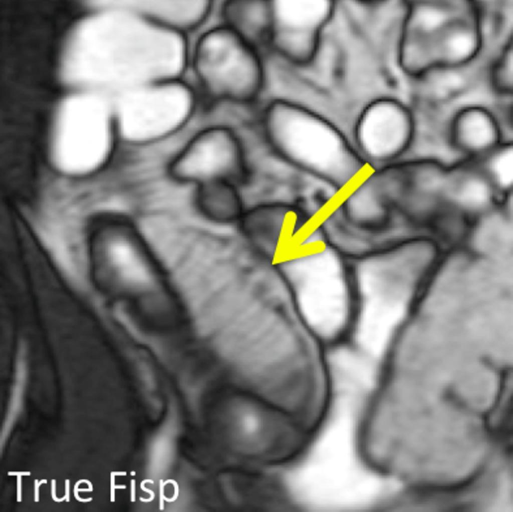 Fig. 18: This image demonstrates the appearance of "cobblestoning" on MRI in Crohn's disease, which is caused by transverse and longitudinal fissuring interspersed by islands of mucosa.