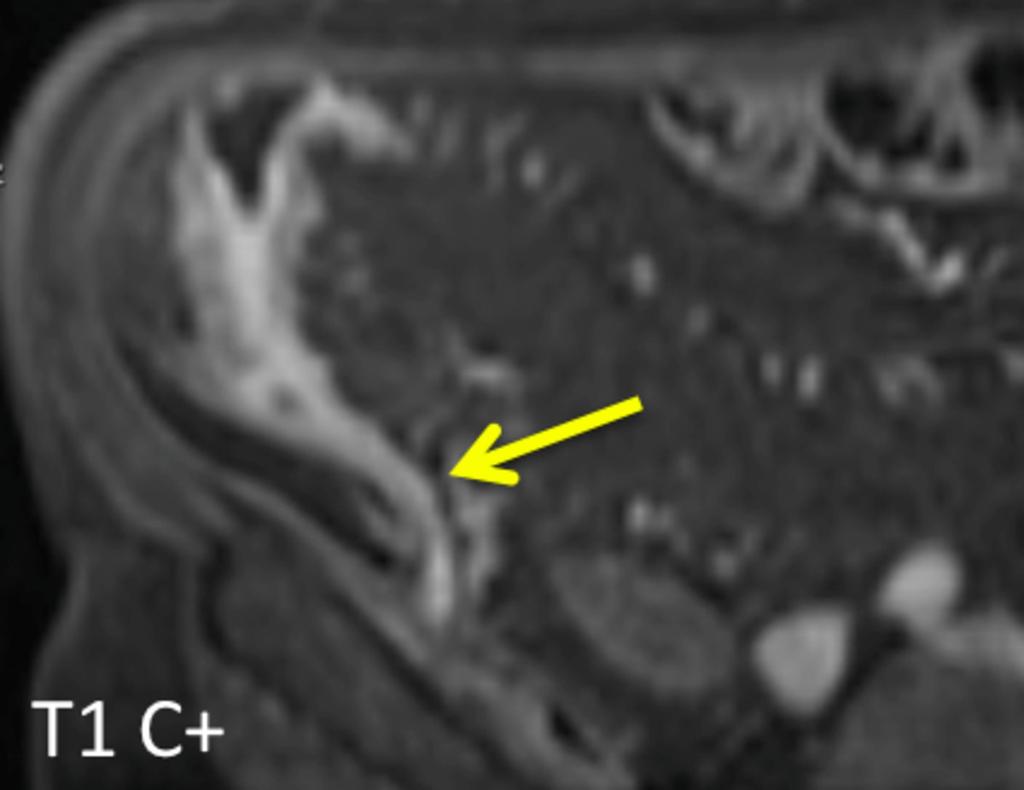 Fig. 21: This image demonstrates a an active enhancing fistula (yellow arrow) between ileum and the right iliacus muscle.