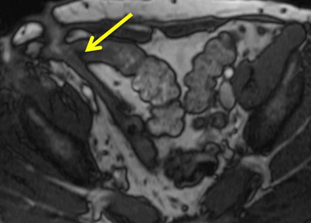 Fig. 23: A True Fisp image demonstrating a low signal chronic fistula