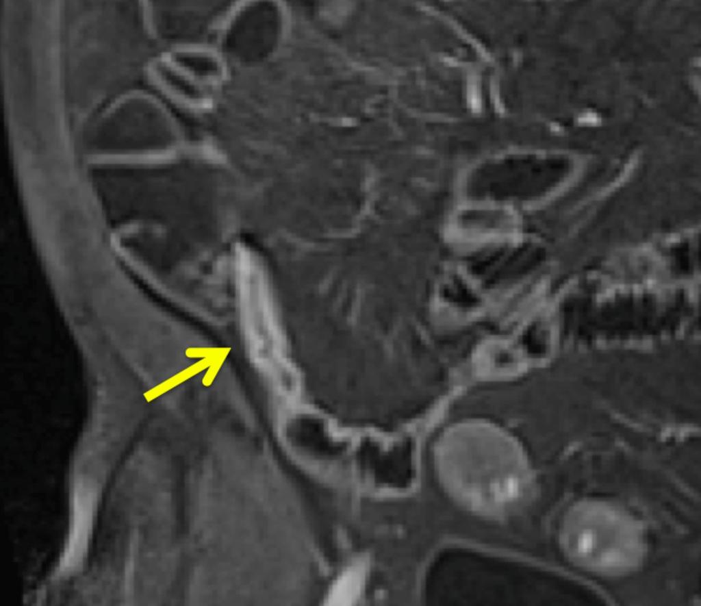 Fig. 24: This T1 post contrast image demonstrates a fibrotic stricture with mild transmural enhancement, rather than a layered
