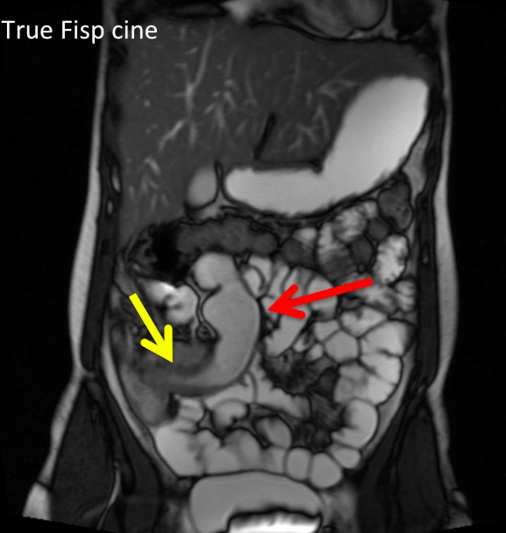 Fig. 25: This still image of a dynamic True Fisp cine study demonstrates a fibrostenotic stricture (yellow arrow), with dilatation of the bowel