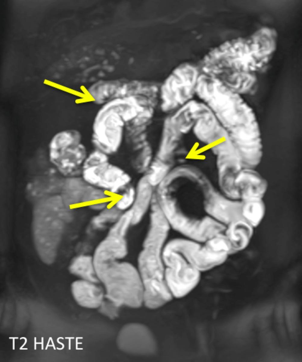 Fig. 27: T2 weighted image demonstrating areas of kinked small bowel (yellow arrows)