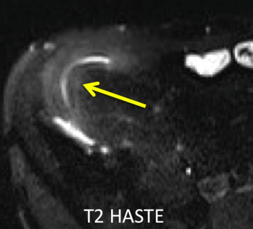 Fig. 2: A T2 weighted image with fat saturation