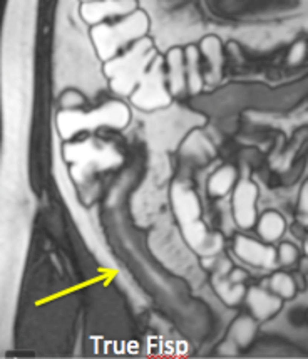 Fig. 3: Bowel wall thickening and a long segment of narrowing in