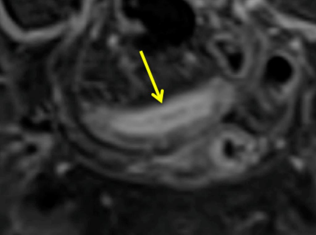 Fig. 4: A T1 post contrast image demonstrating layered or stratified wall enhancement,