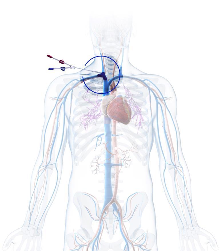 CVO a significant problem in vascular access An estimated 2M people worldwide require treatment with dialysis or kidney transplant to stay alive 1 But Central venous catheters (CVCs) continue to be