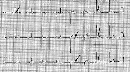 EKG of hypertrophic cardiomyopathy 33 yo man with HCM.