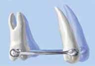 Phase I: Carriere Distalizer. Carriere Distalizer provides molar rotation and uprighting. Independently moves each posterior segment, from canine or premolar to molar, as a unit.