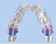 The distalizer is directly bonded to the buccal surface of the first molar and either the maxillary cuspid or first bicuspid.
