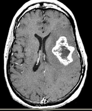 Glioblastoma (GBM) Most common primary malignant brain tumor Approx.