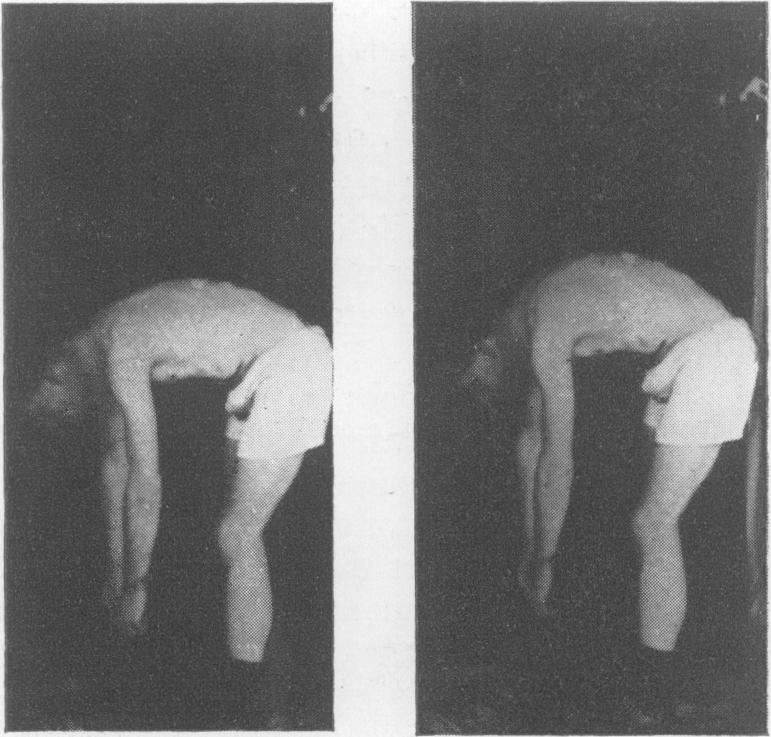 402 POSTGRADUATE MEDCAL JOURNAL July 1952,1 / *.* %..*.* ' -.. - B. % N N N FG. 2.-Tracings of lateral radiographs of the lumbar spine and sacrum taken with the patient standing: A. Fully flexed. B. Erect.