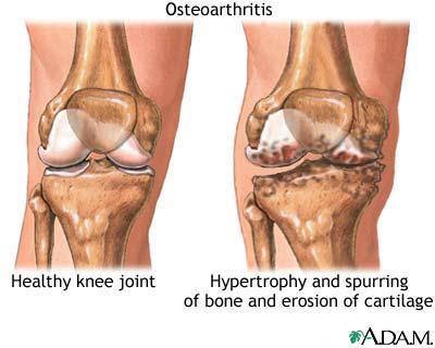 Pain is a sign that something in your body needs attention, and there are OPTIONS beyond just putting up with it! WHAT IS OSTEOARTHRITIS?