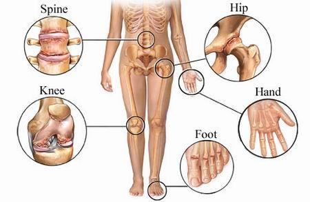 Osteoarthritis is the thinning of the shock absorbing cushioning between the bones, known as cartilage.