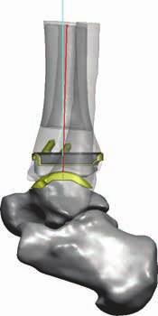 traditional Total Ankle System while reducing surgical and