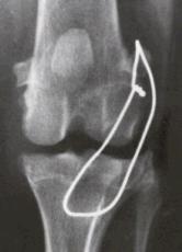 The torn or partly torn cruciate ligament is removed. Any bone spurs of significant size are bitten away with an instrument called a rongeur. If the meniscus is torn, the damaged portion is removed.