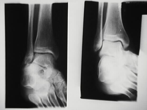 Ankle Mortise & Oblique Film Oblique on right.