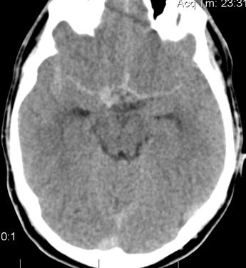 Romanian Neurosurgery (2015) XXIX 3: 286-290 287 Native CT scan at admission Right carotid artery angiography CT angio reconstructions CT angio