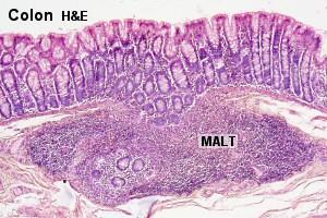 Often MALT consists of small accumulations of lymphoid cells or one to a few lymph follicles beneath