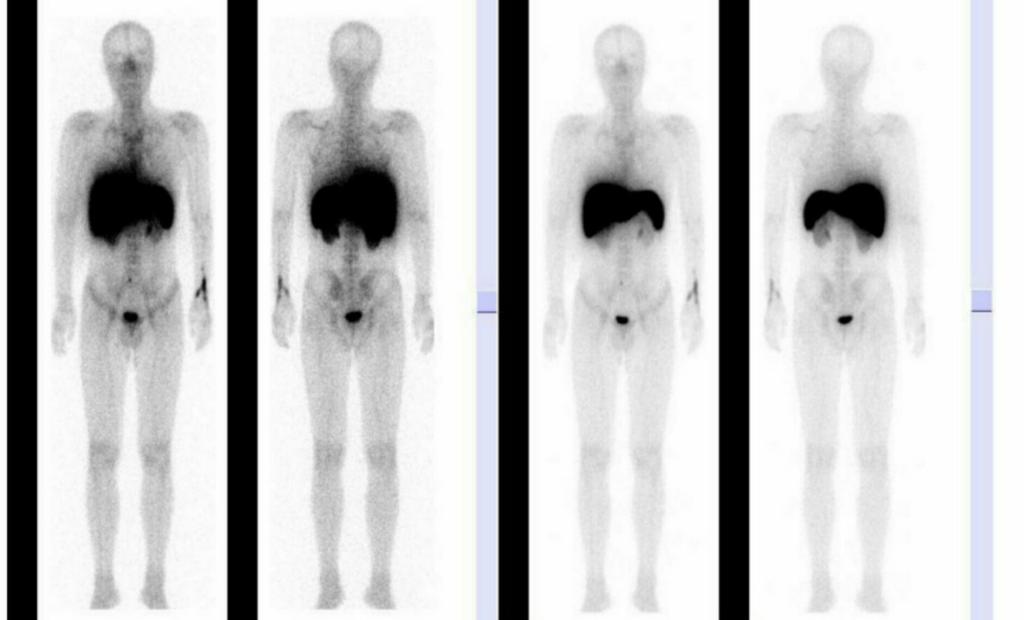 Figure 3. Bone marrow imaging after suspending granulocyte colony-stimulating factor treatment.