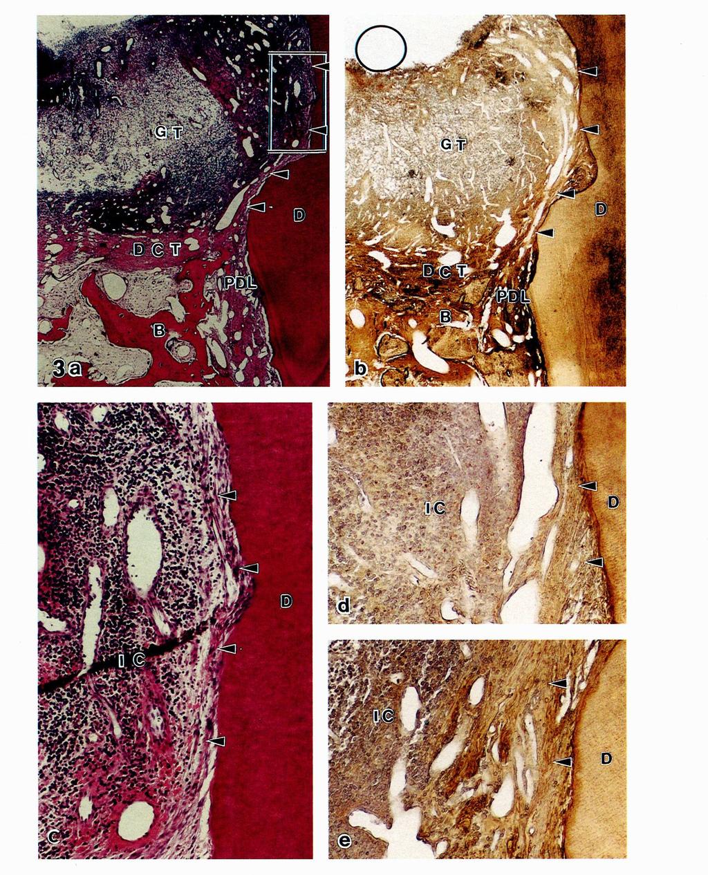 on the root surface (H&E staining), b Note intense staining for CI in the newly-formedfibrous connective tissue on the root surface (arrowheads), dense connective tissue (DCT) on bone (B), PDL, and