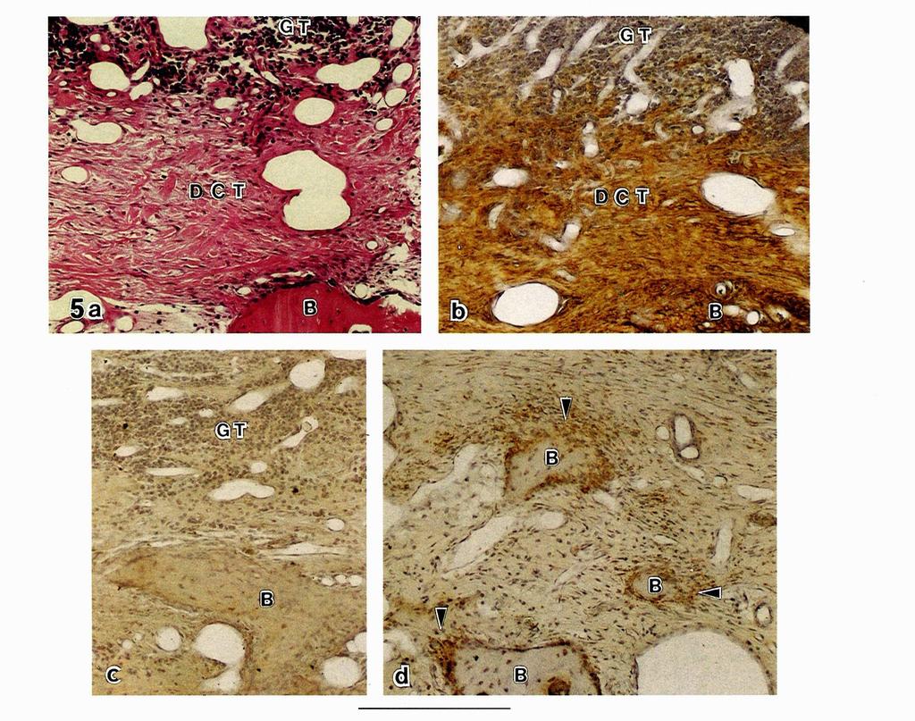 immunostaining for CI was observed in dense connective tissue (DCT) and bone (B), but not in granulation tissue (GT).