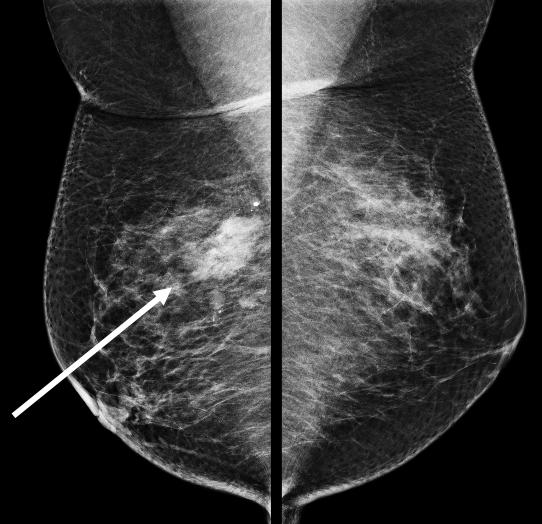38 Imaging of the Breast Technical Aspects and Clinical Implication (a) Fig. 5.