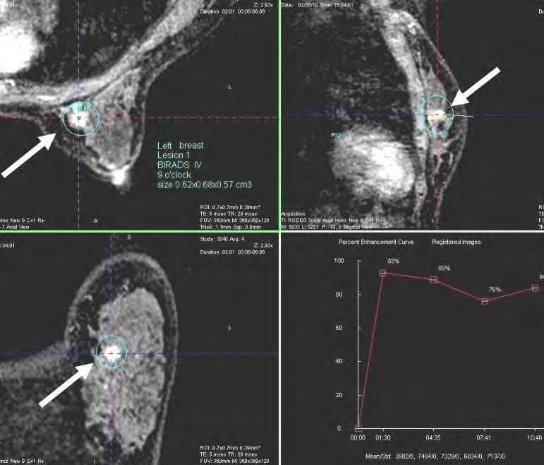 The Application of Breast MRI on Asian Women (Dense Breast Pattern) 41 (a) (b) Fig. 9.