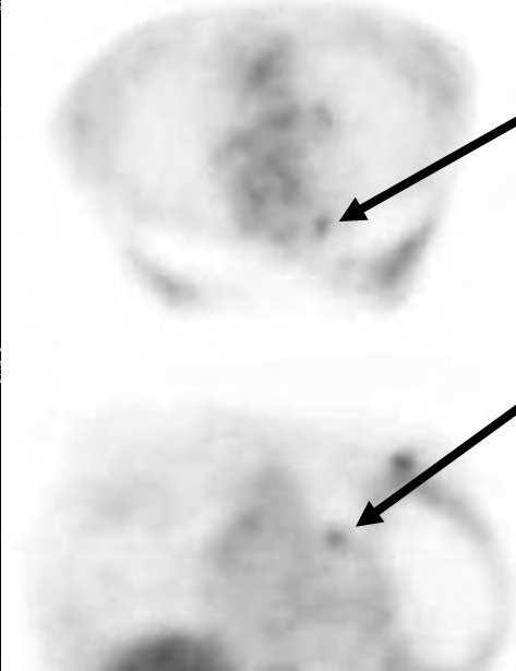 (a) Breast MRI shows suspect enlarged lymph node at
