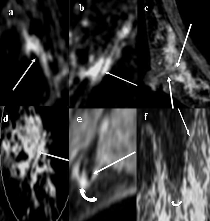48 Imaging of the Breast Technical Aspects and Clinical Implication scattered and widely distributed DCIS is difficult, which is one possible explanation for the frequent mismatch between MRI and