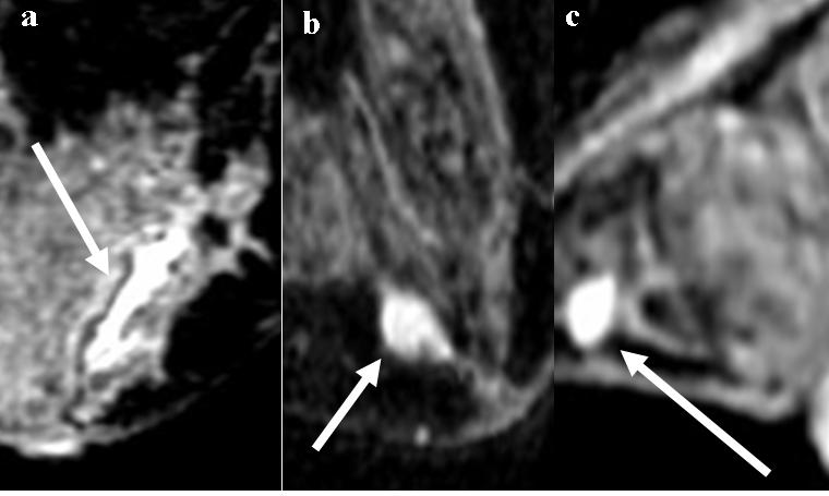 The Application of Breast MRI on Asian Women (Dense Breast Pattern) 49 Non-DCIS early ductal lesions, including intraductal papilloma, ductal hyperplasia, and early focal IDC, can be visualized using