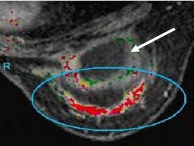The Application of Breast MRI on Asian Women (Dense Breast Pattern) 53 Harris et al., 1993; Venta et al., 1996).