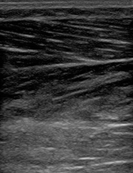 striae seen within muscle Hyperechoic