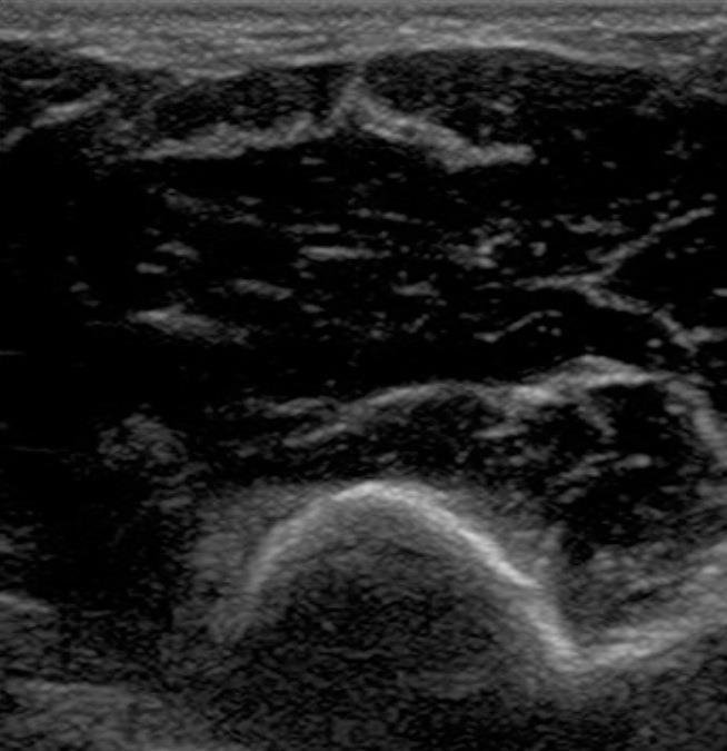 Muscle Imaging on Ultrasound Muscle