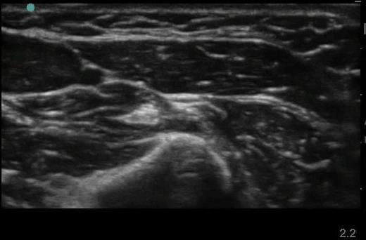 What do Nerves look like on Ultrasound?